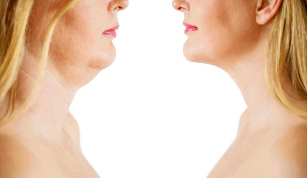 Double Chin treatment Woolwich before and after results