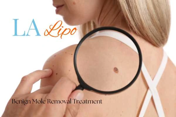 Woman having her inspection of blemish before mole removal Woolwich