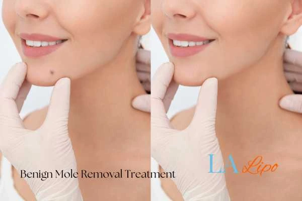 Before and after mole removal Woolwich treatment