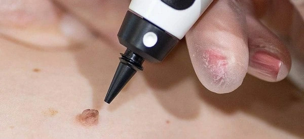 skin tag removal using cryopen Woolwich