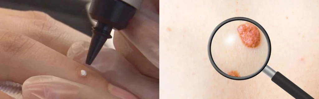 Person getting moles removed with cryopen Woolwich