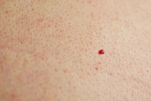 close up of a cherry angioma Woolwich