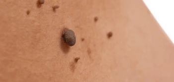 image of a skin tag Woolwich