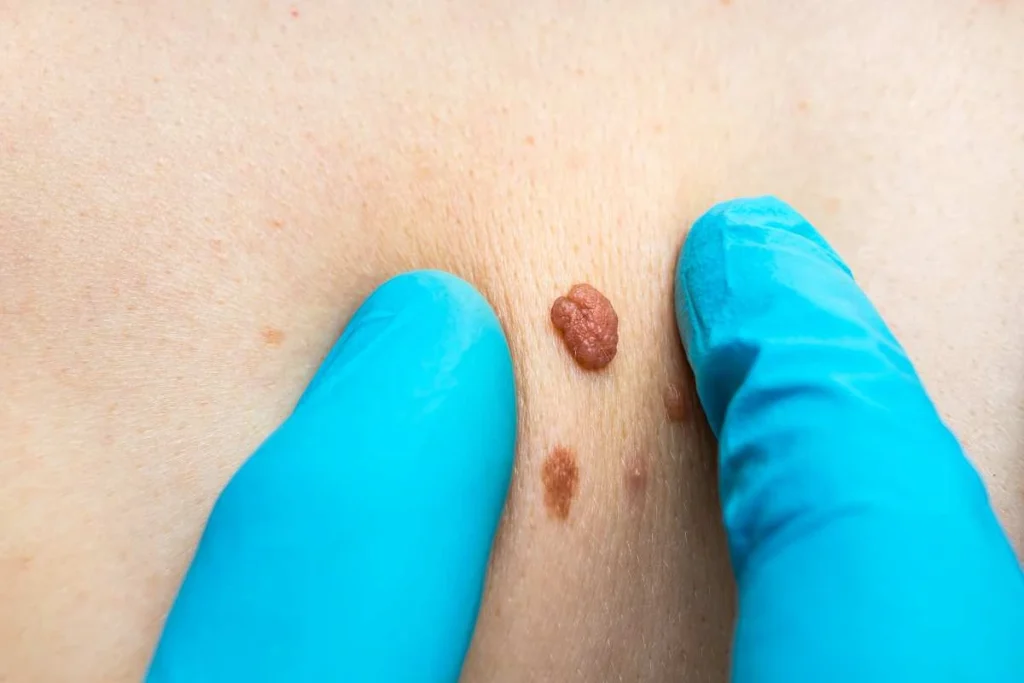 Consultant examining a skin tag Woolwich