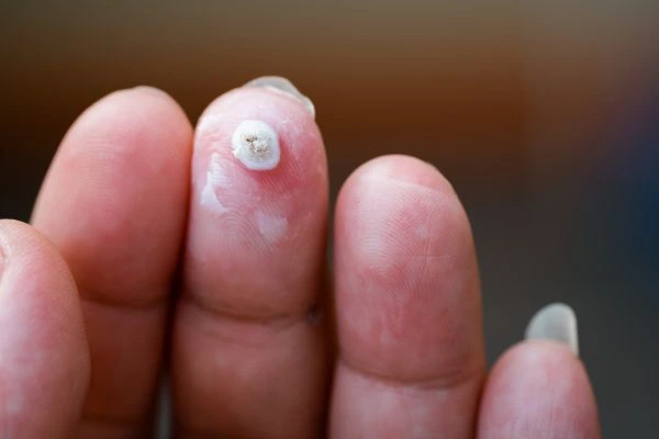 wart on person finger - cryotherapy to treat from LA LIPO Woolwich